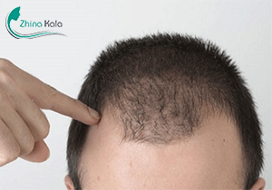 درمان ریزش موی سر